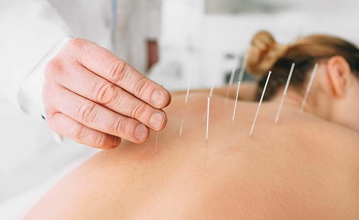 This is a guide on how to start a career as an acupuncturist.